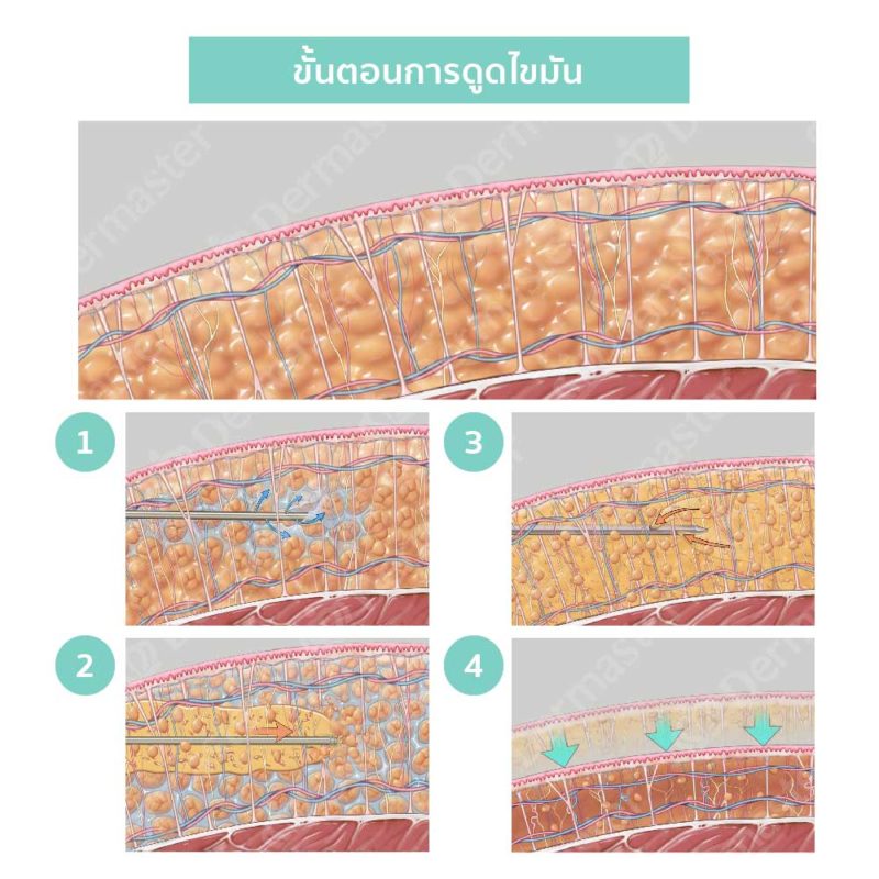ขั้นตอนการดูดไขมัน vaser