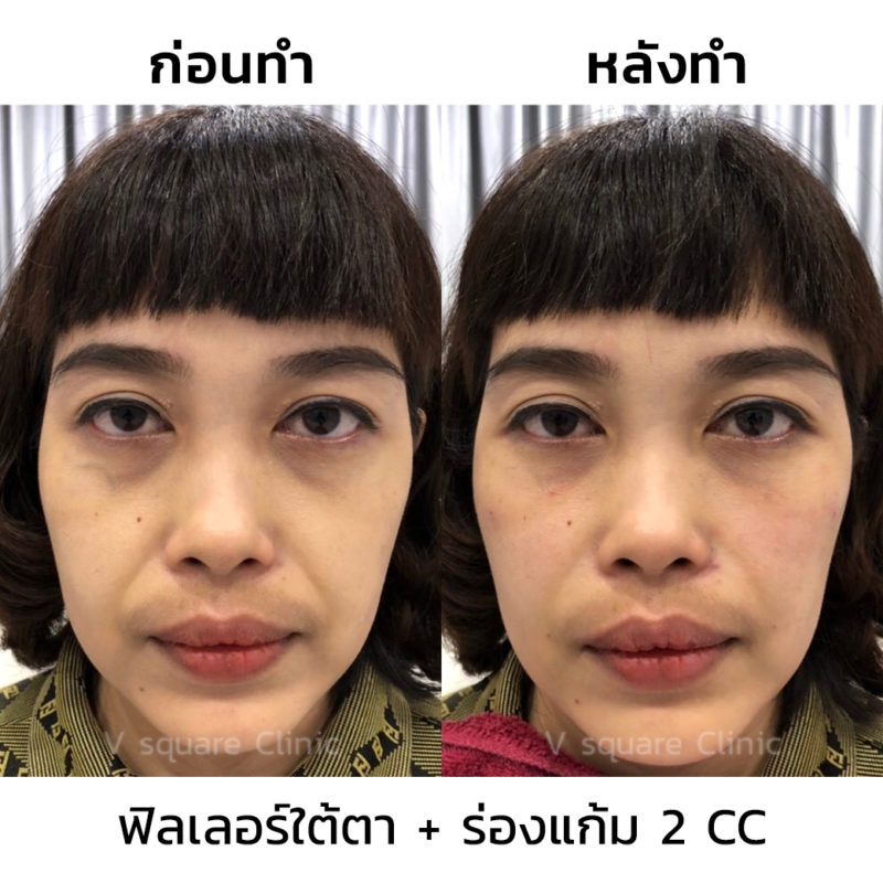 รีวิวฉีดฟิลเลอร์