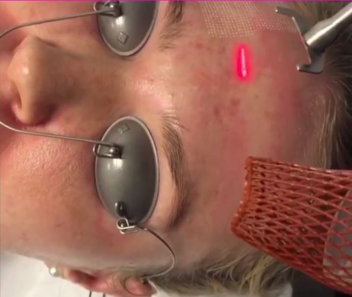 เลเซอร์หลุมสิว Fraxel Lasers