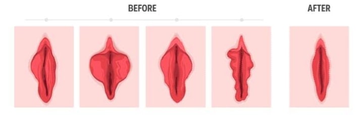 ศัลยกรรมตกแต่งเลเบีย แคมเล็ก