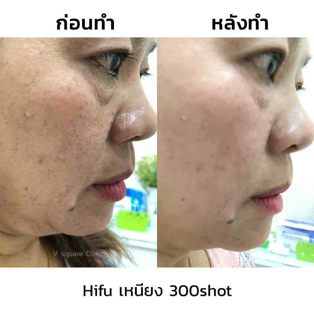 review-hifu-เหนียง-300shot