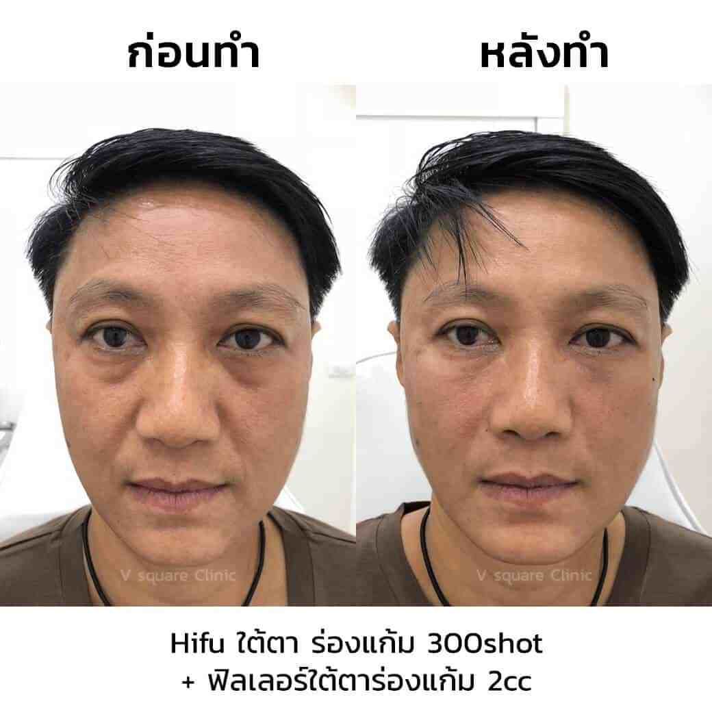 review-hifu-ใต้ตา-ร่องแก้ม-300shot-ฟิลเลอร์ใต้ตาร่องแก้ม