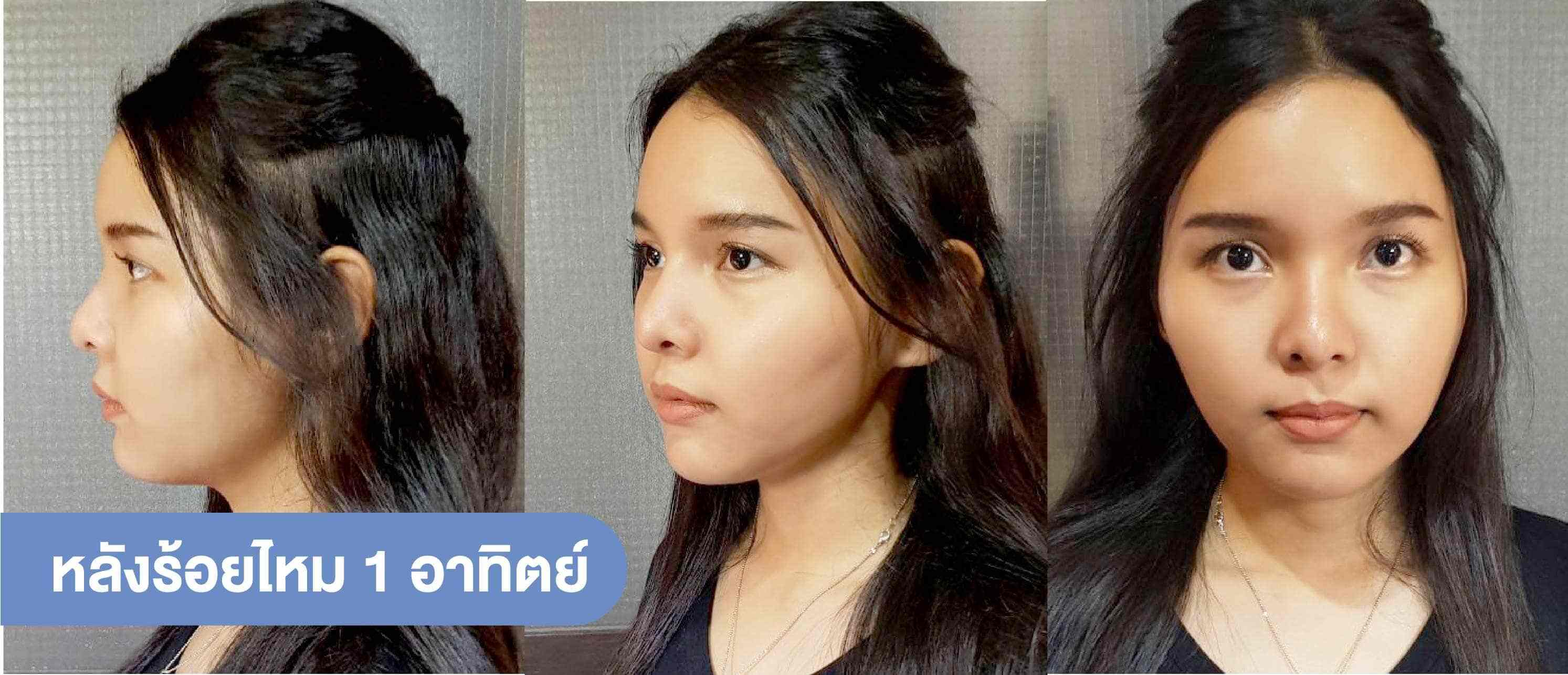 รีวิวหลังร้อยไหม-1อาทิตย์