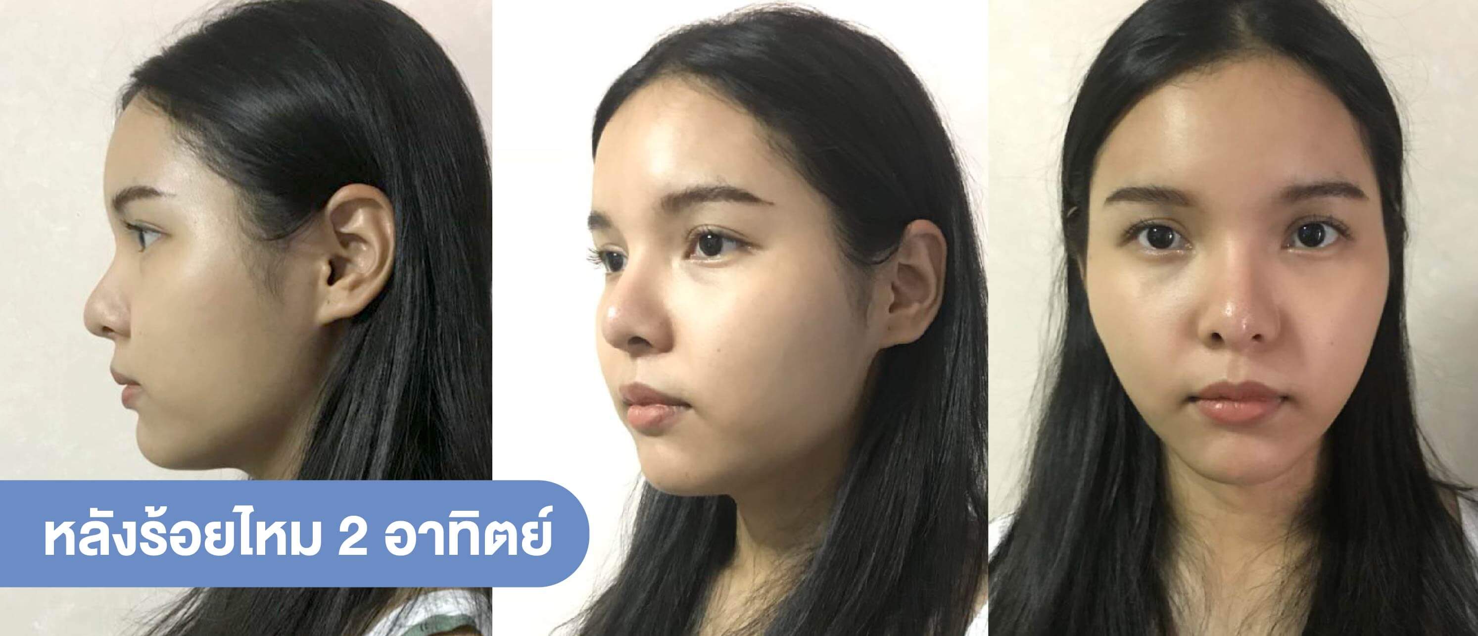 รีวิวหลังร้อยไหม-2 อาทิตย์