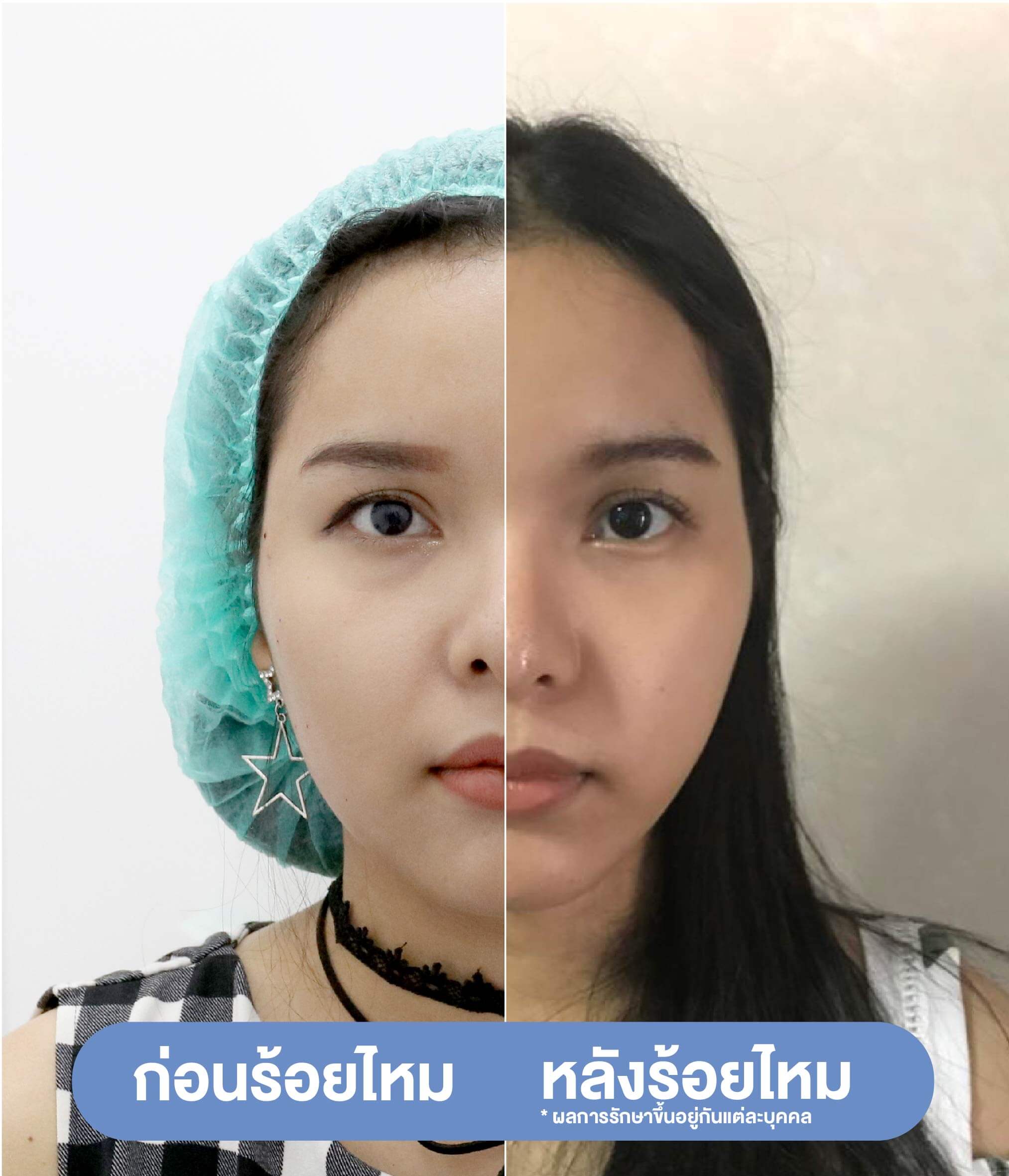 รีวิวก่อน-หลังร้อยไหมก้างปลา