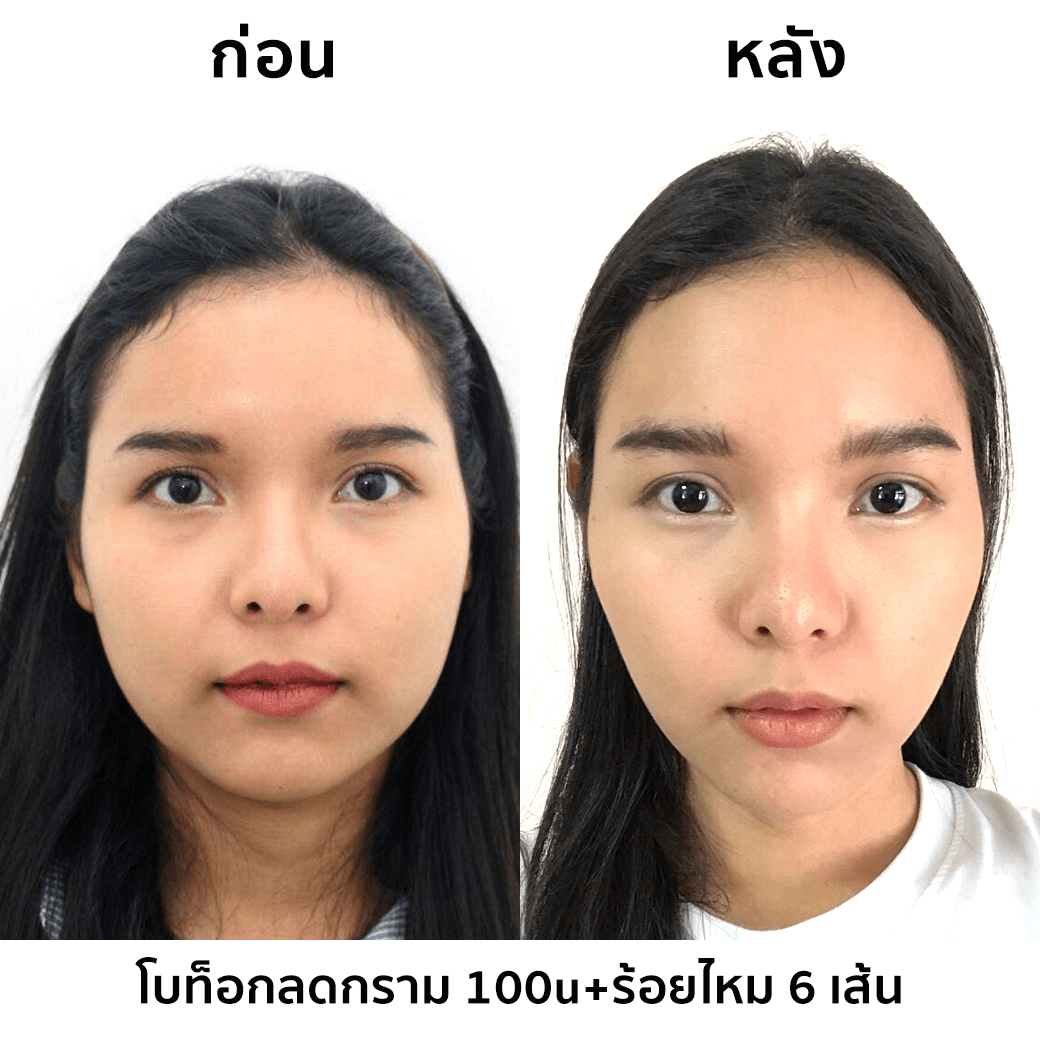 รีวิวโบท็อกลดกราม-และร้อยไหม-6-เส้น