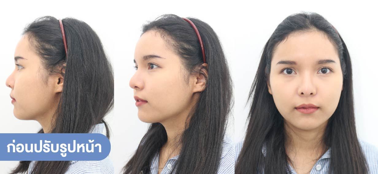 โบท็อกลดกราม