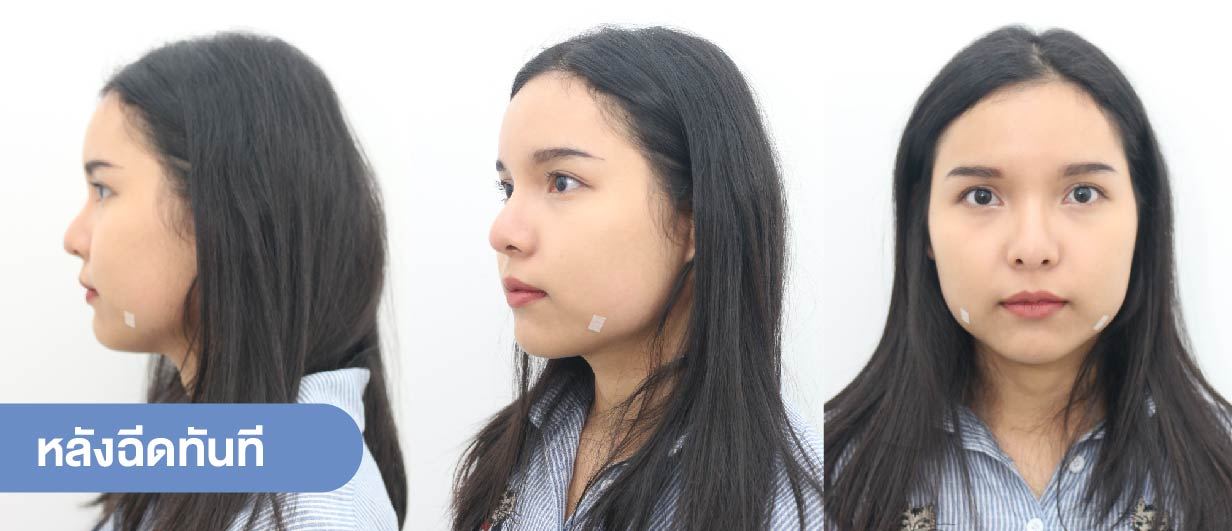 โบท็อกลดกราม