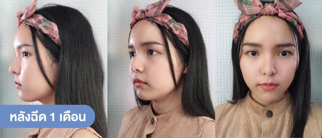 โบท็อกลดกราม