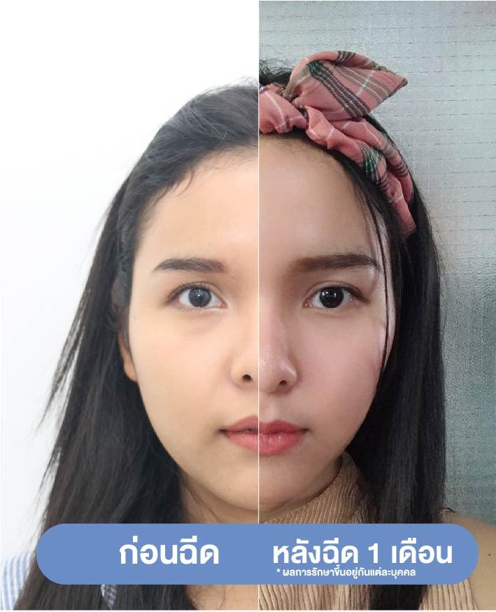 ฉีดโบท็อกลดกราม before-after 1 เดือน