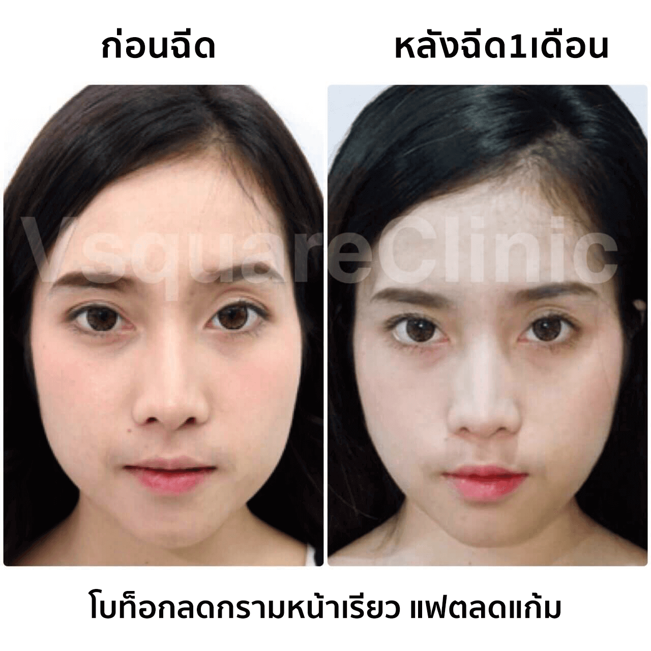 รีวิวโบท็อกลดกรามหน้าเรียว-แฟตลดแก้ม