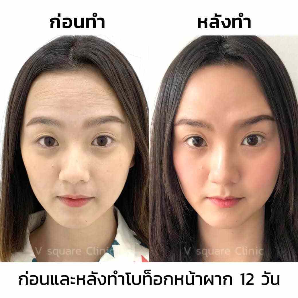 หลังฉีดโบท็อก-12-วัน