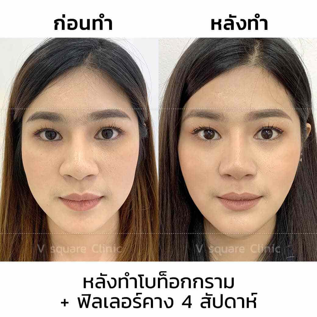 โบท็อกลดกรามและฟิลเลอร์คาง_หลังทำ4สัปดาห์