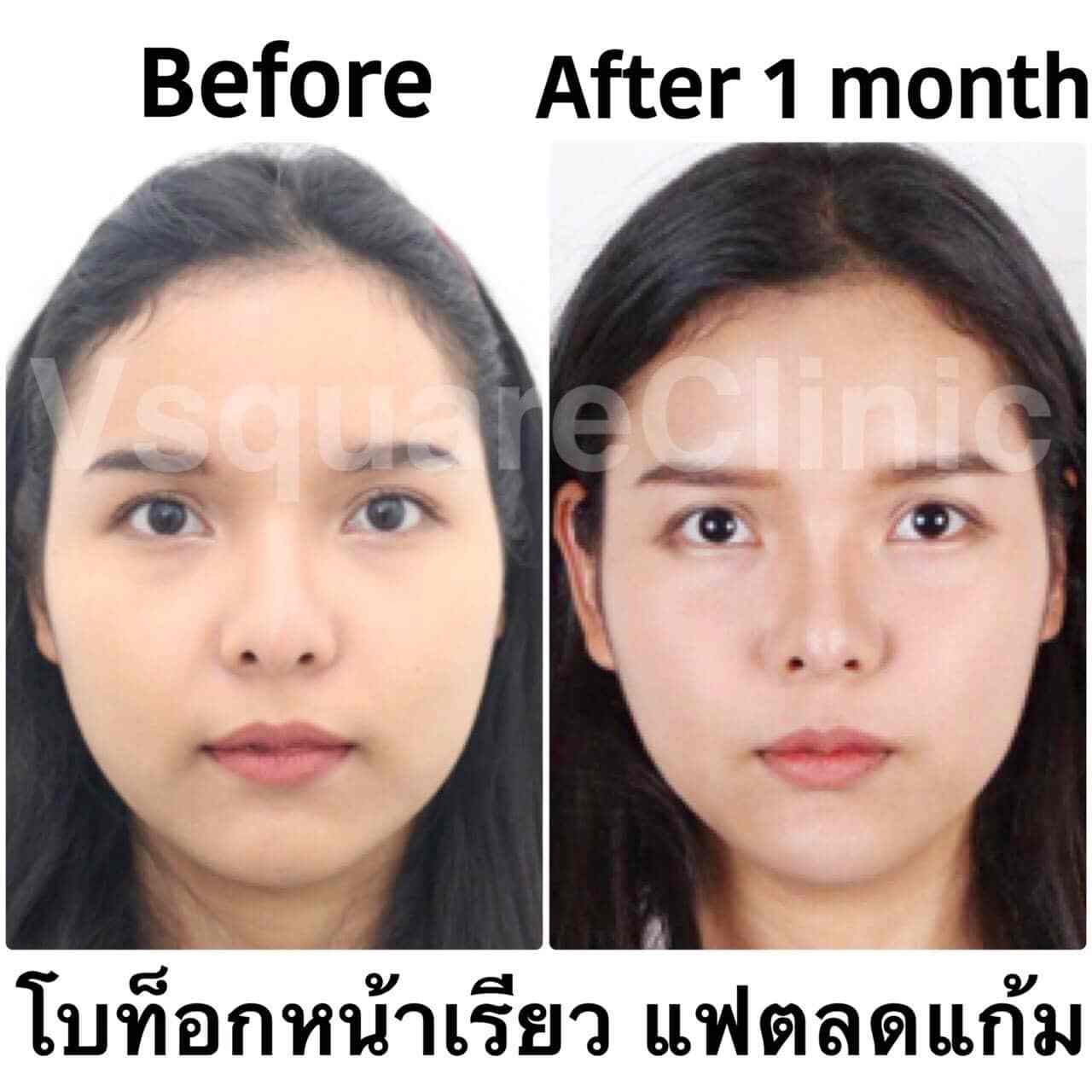 รีวิว ฉีดโบท็อก อันตรายไหม