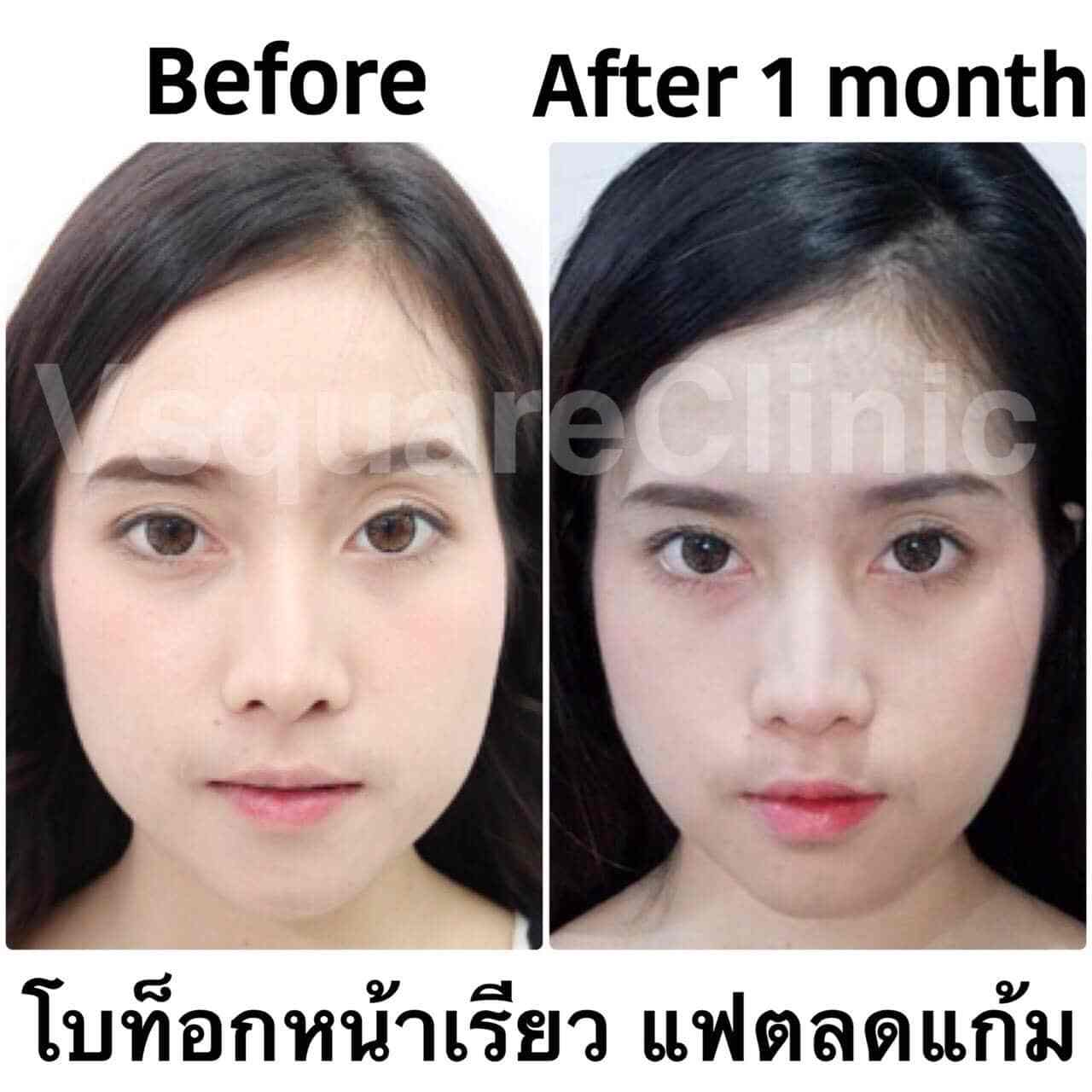 รีวิว ฉีดโบท็อก อันตรายไหม