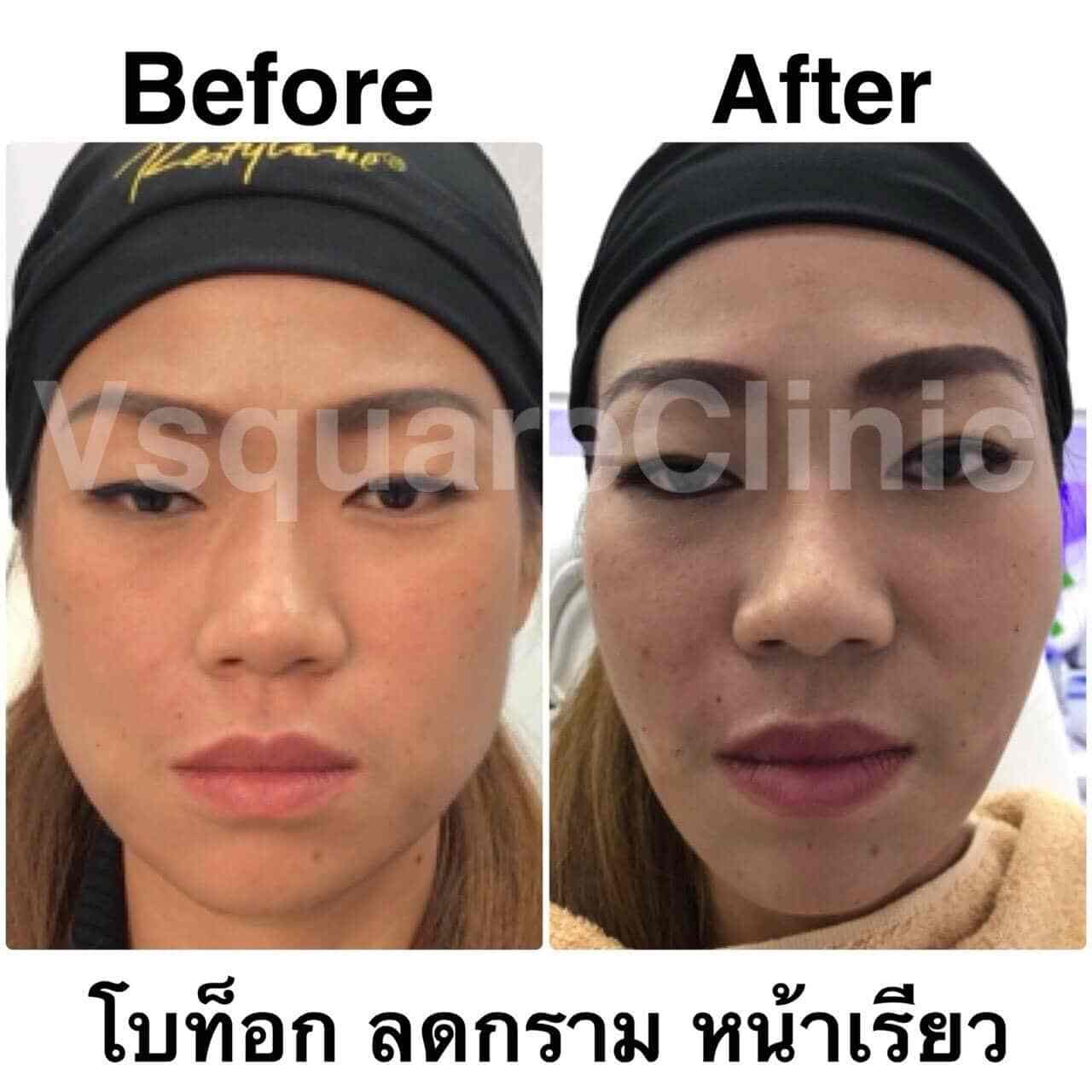 รีวิว ฉีดโบท็อก อันตรายไหม