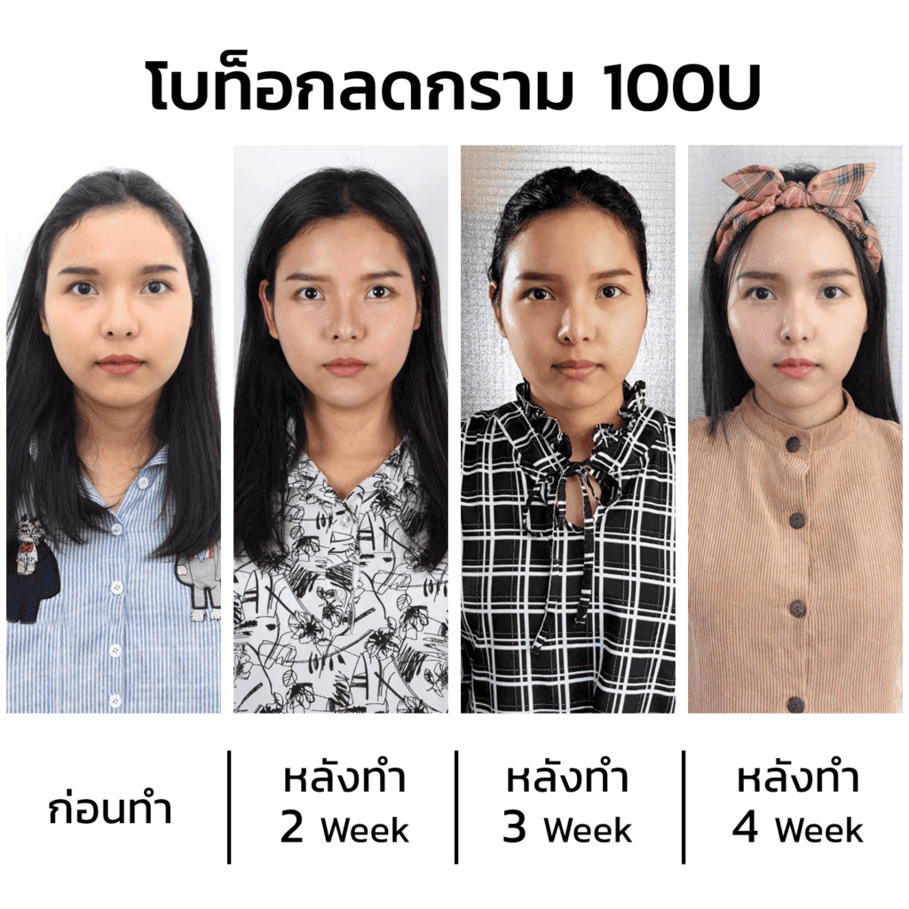 ฉีดโบท็อกลดกราม100-unit