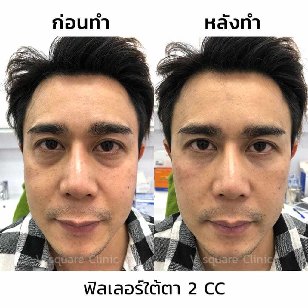 ฟิลเลอร์ใต้ตา-2CC