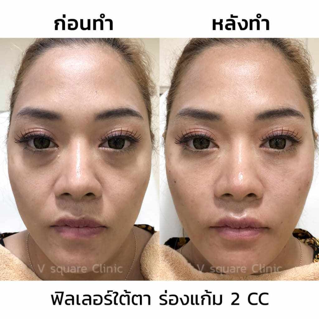 ฟิลเลอร์ใต้ตาร่องแก้ม-2CC