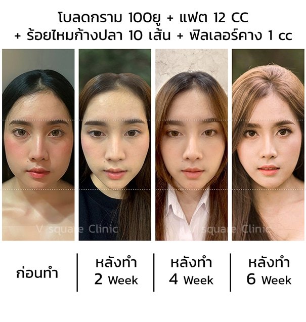 รีวิว ฉีดโบท็อกลดกราม100u แฟต ร้อยไหม ฟิลเลอร์คาง
