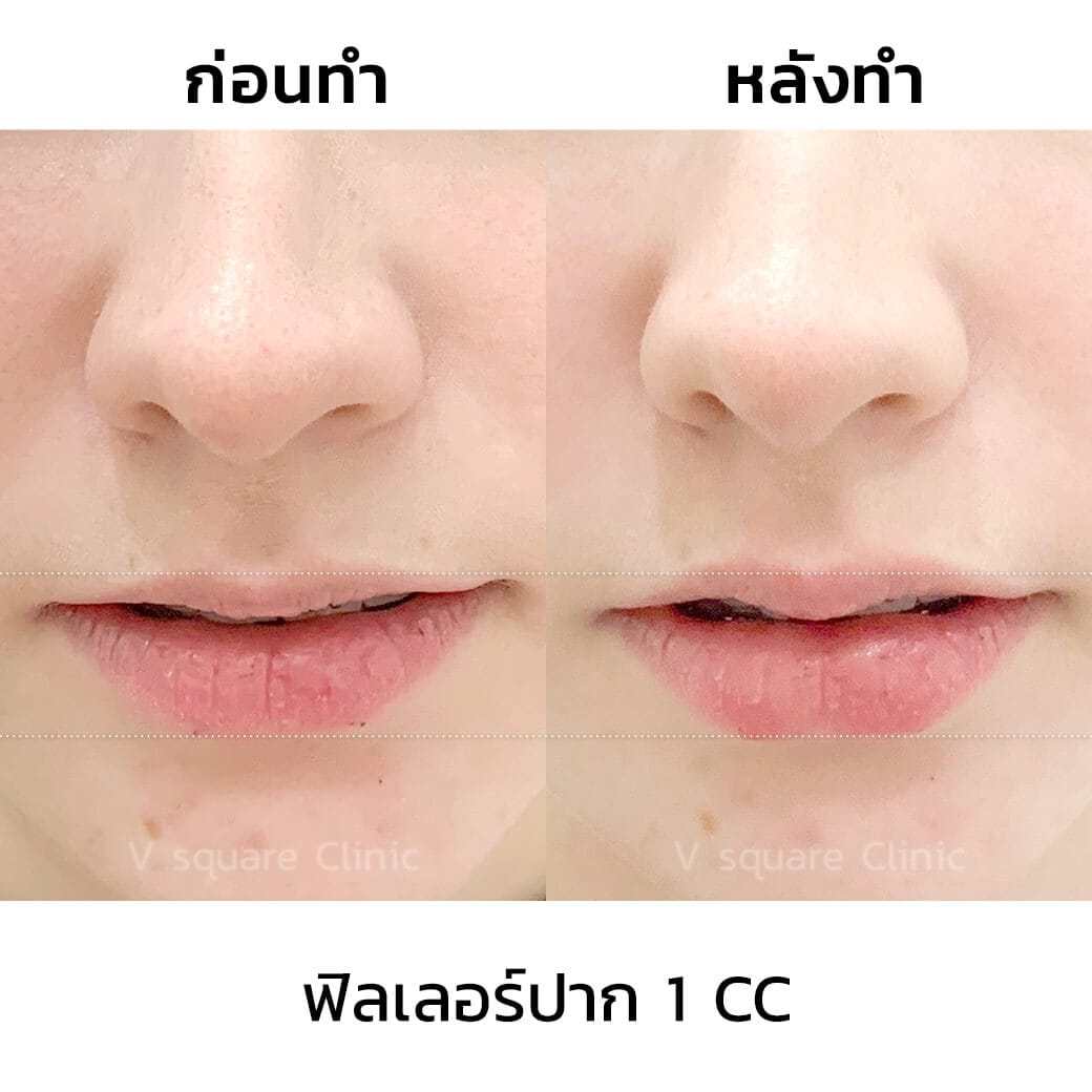 รีวิว-เจสซี่_ฟิลเลอร์ปาก1cc