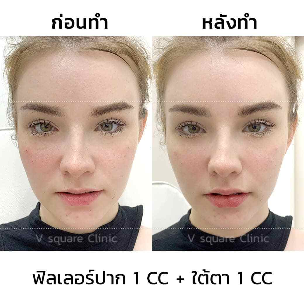รีวิว-เจสซี่_ฟิลเลอร์ปาก1ccใต้ตา1cc