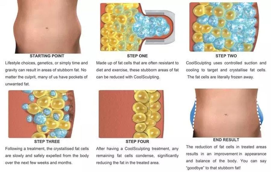 Coolsculpting-นิยมทำส่วนไหน