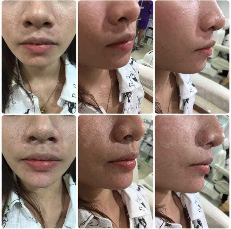 รีวิวฟิลเลอร์คาง