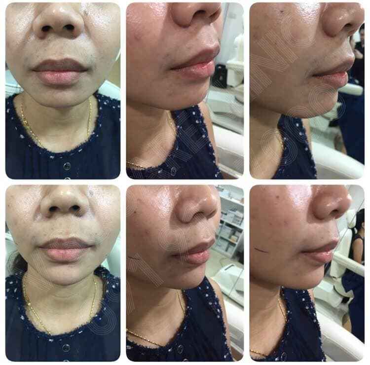 รีวิวฟิลเลอร์คาง