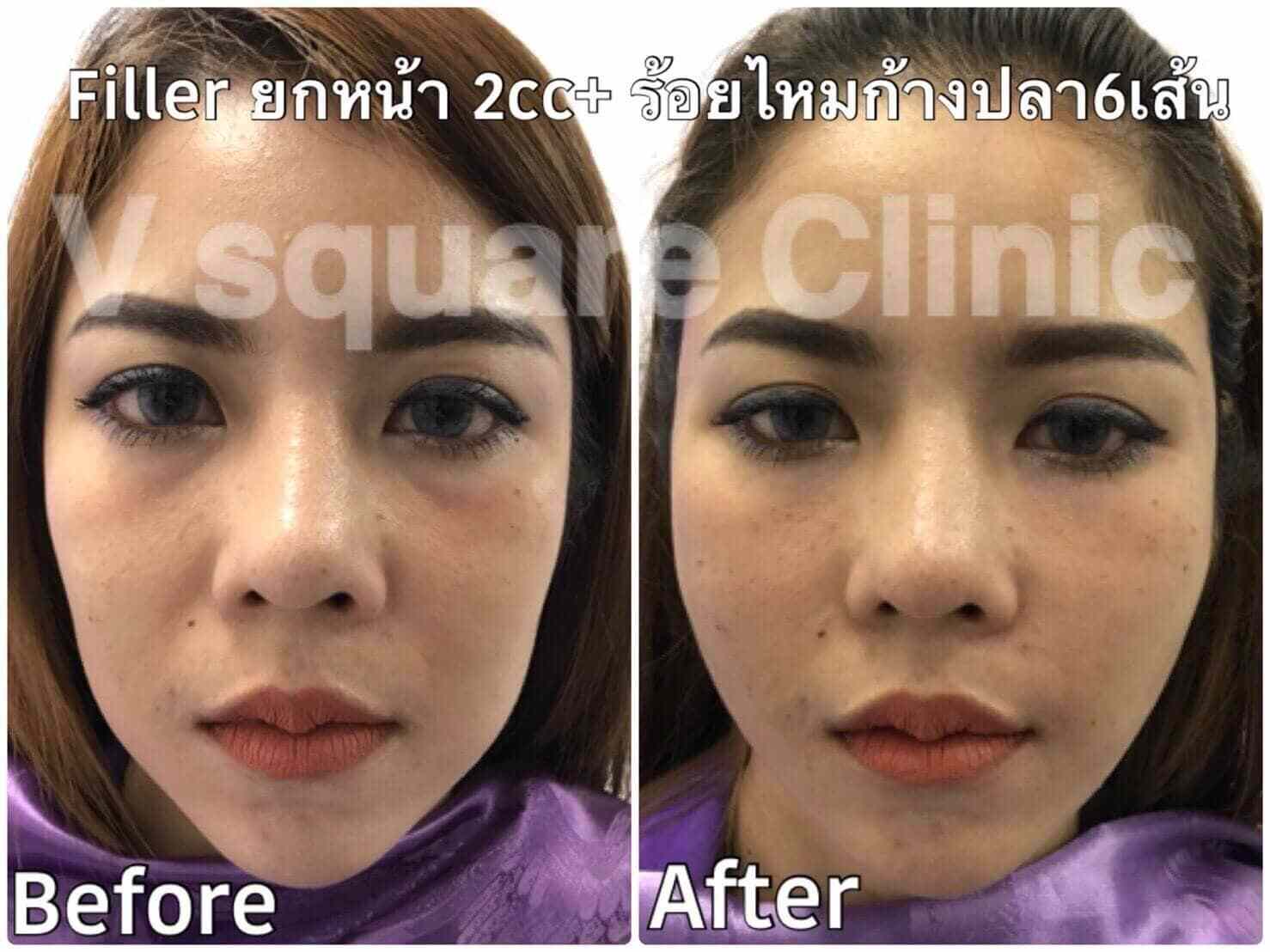รีวิวฟิลเลอร์ยกหน้าและร้อยไหมก้างปลา