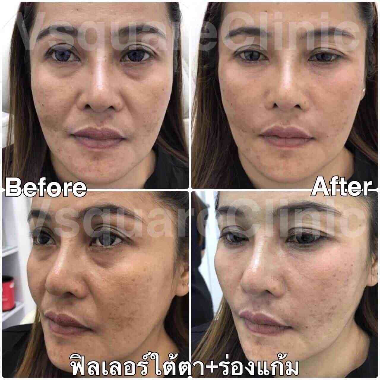 รีวิวฟิลเลอร์ใต้ตาและฟิลเลอร์ร่องแก้ม