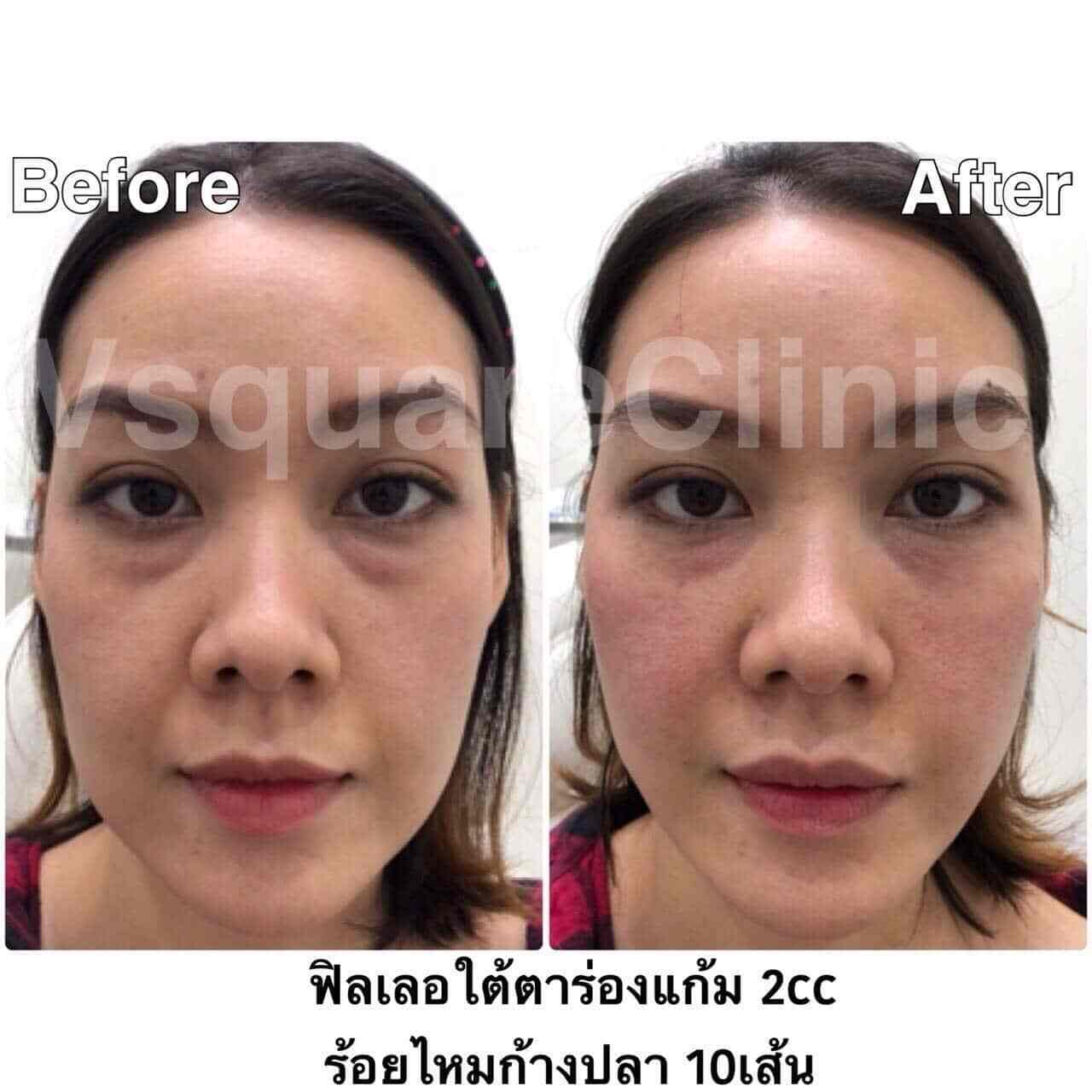 รีวิวฟิลเลอร์ใต้ตาและร้อยไหมก้างปลา