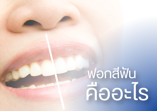 ฟอกสีฟัน-ฟอกฟันขาว คืออะไร
