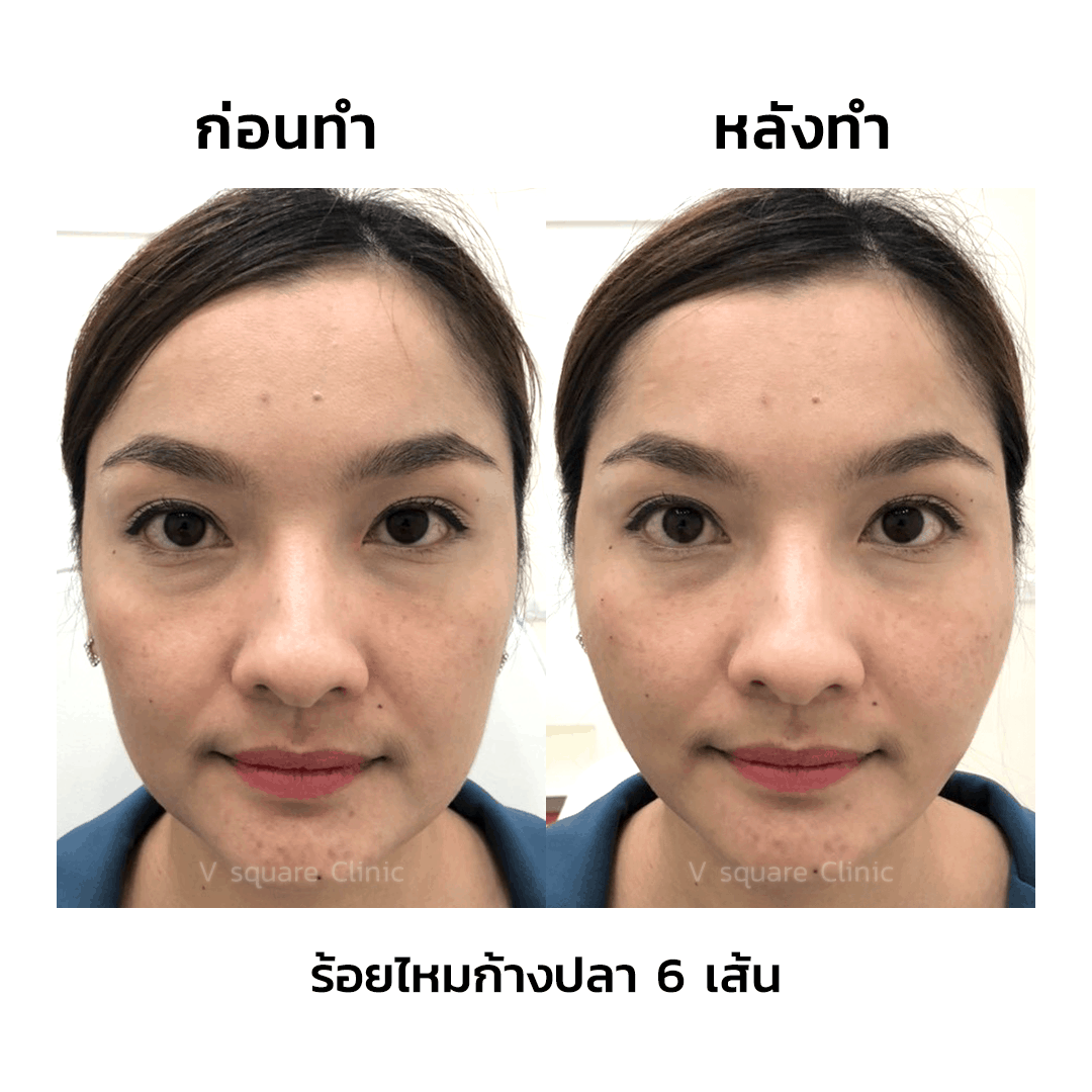 รีวิวร้อยไหม-6