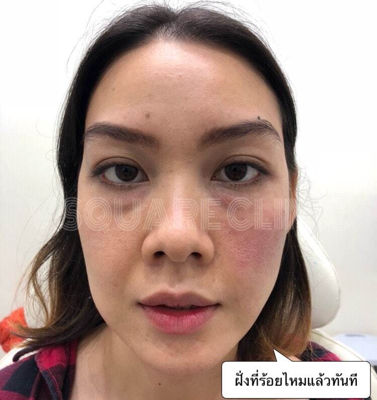 รีวิวร้อยไหม