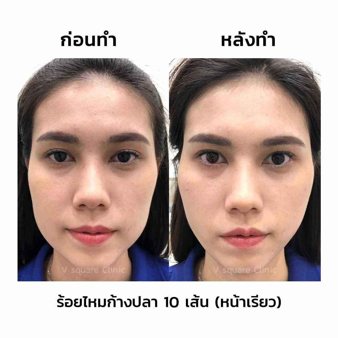 รีวิว ร้อยไหมก้างปลา