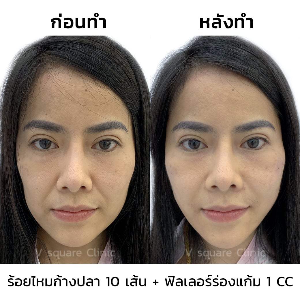 รีวิว ร้อยไหมก้างปลา