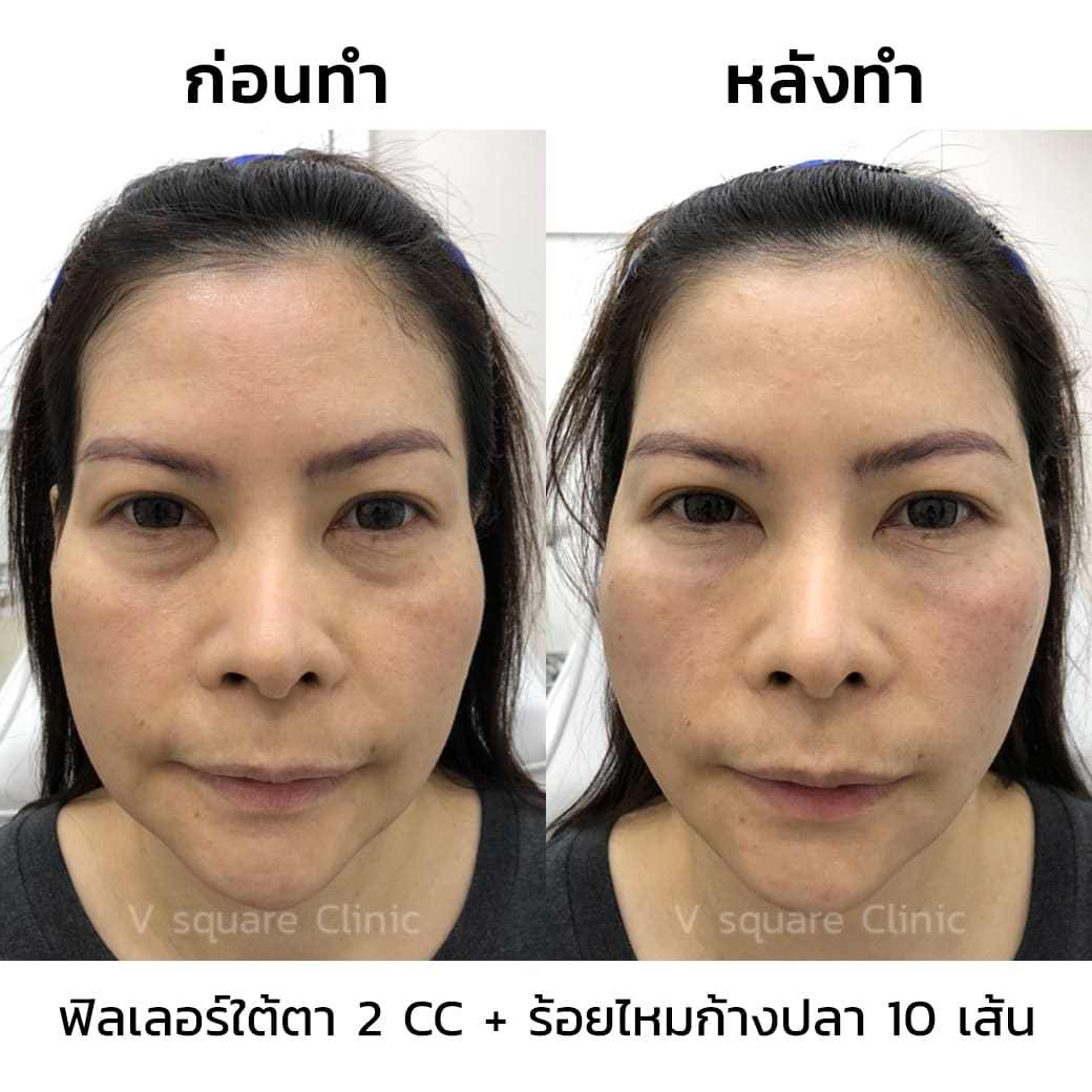รีวิว ร้อยไหมก้างปลา