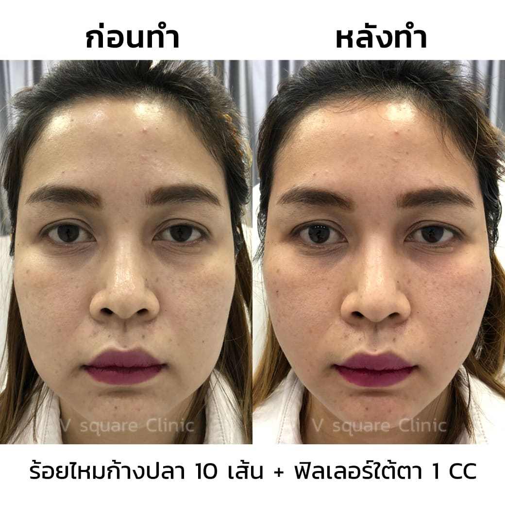 รีวิวร้อยไหม-5