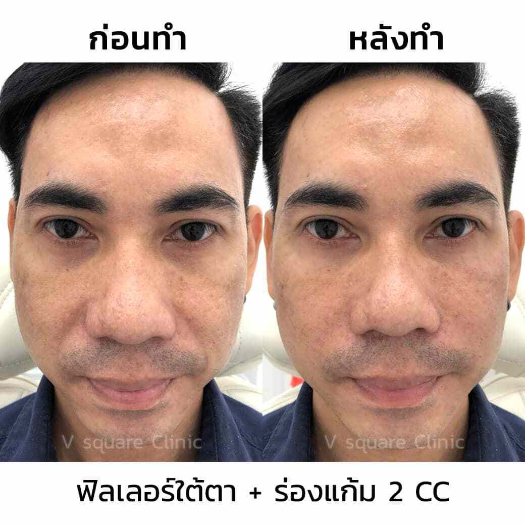 รีวิวฟิลเลอร์ร่องแก้ม