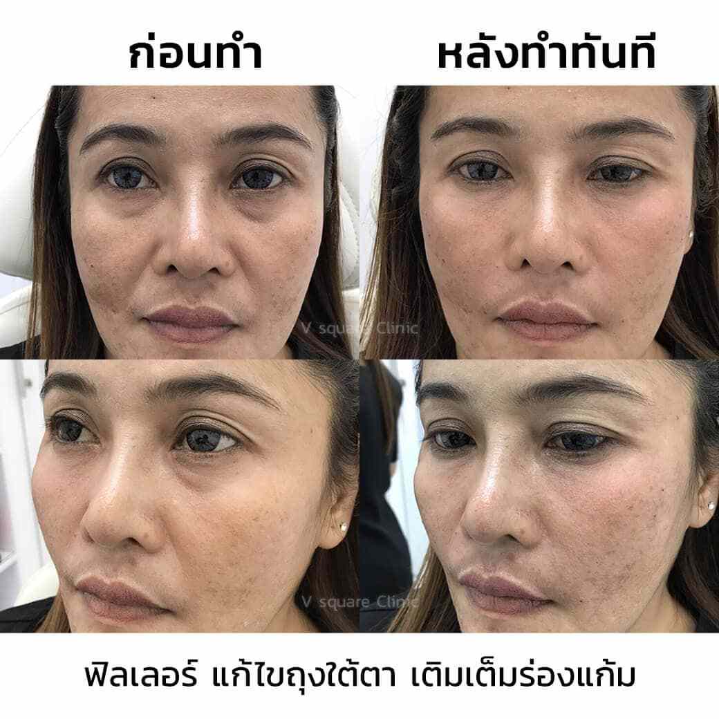 รีวิวฟิลเลอร์ร่องแก้ม
