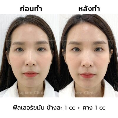 รีวิวฟิลเลอร์คางและฟิลเลอร์ขมับ
