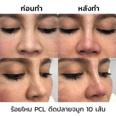 ร้อยไหมจมูกเหมาะกับใคร-มีข้อเสียอะไรบ้าง