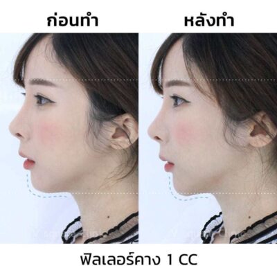 ฟิลเลอร์คาง-1-cc_ด้านข้าง