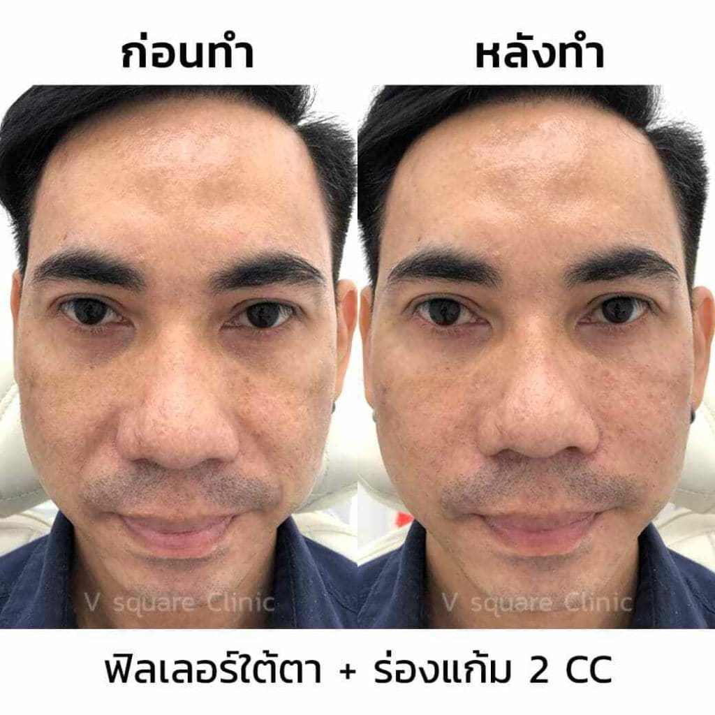 รีวิว ฉีดฟิลเลอร์ร่องแก้ม