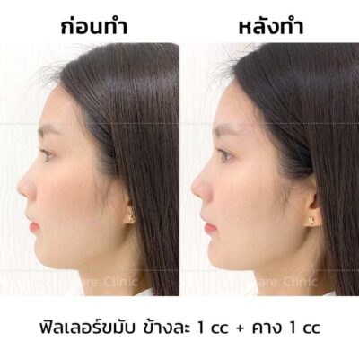 เติมฟลิลเลอร์ขมับข้างละ-1-cc
