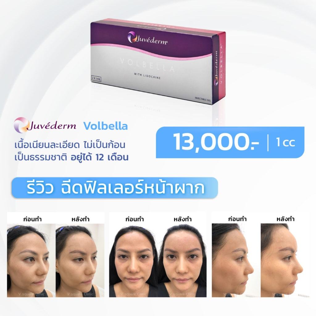 โปรโมชั่นฉีดฟิลเลอร์หน้าผาก