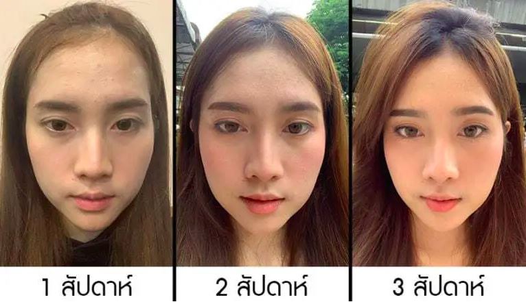 รีวิวฉีดโบท็อกลดแก้ม