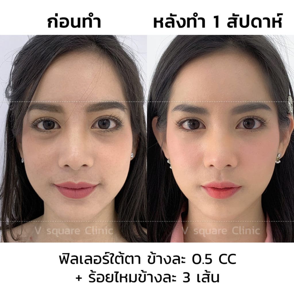 รีวิวฟิลเลอร์ใต้ตา-ข้างละ0dot5cc