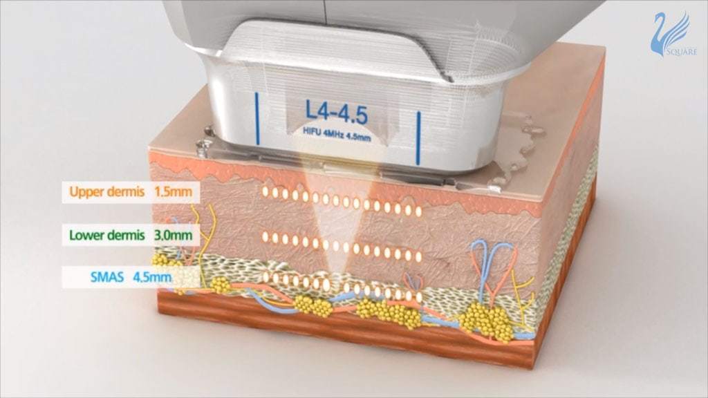Ulthera-ความลึกในการยิงของหัวอัลเทอร่า